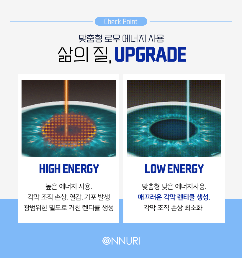 스마일라식 1mm각막수술이란?