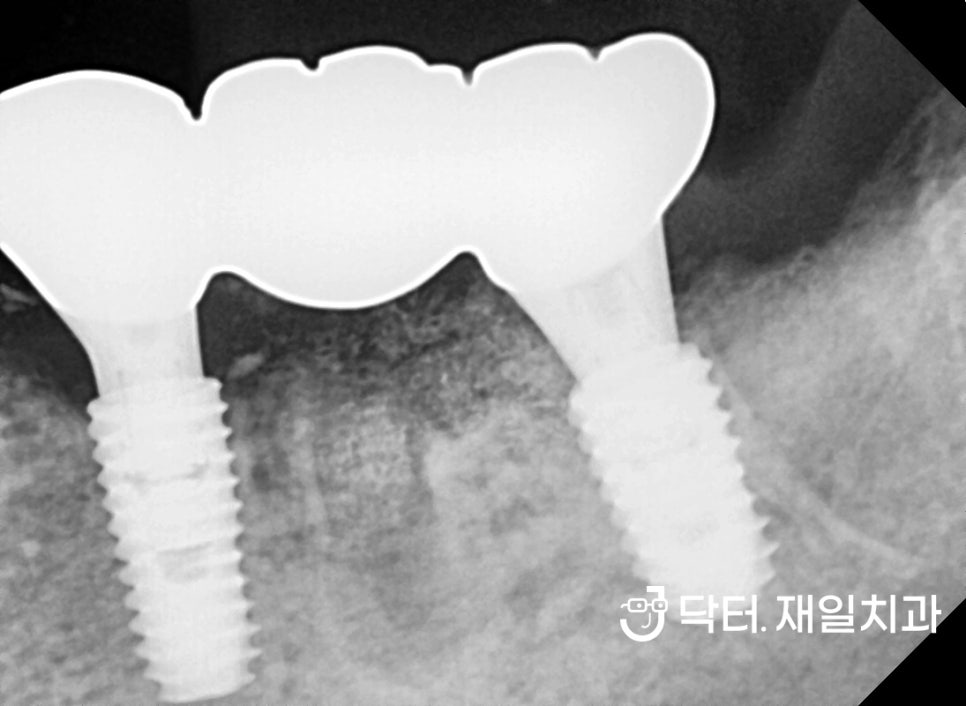 어금니 임플란트 수술이 필요한 치과마취트라우마 30대 환자분 당일 수면마취로 명일동 상일동역임플란트 치과에서 크라운 신경치료까지 한번에