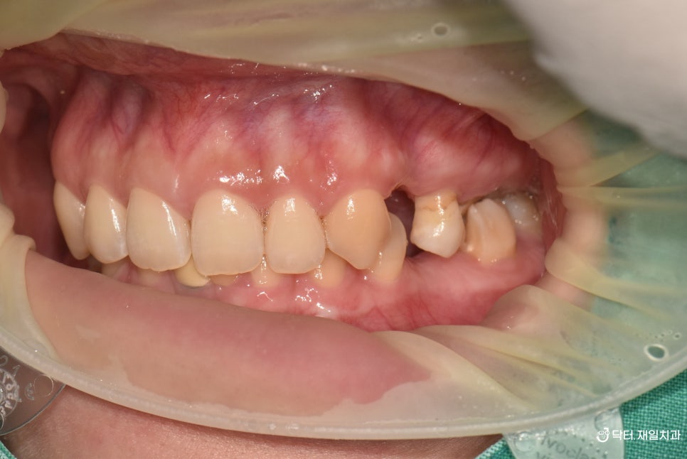 어금니 임플란트 수술이 필요한 치과마취트라우마 30대 환자분 당일 수면마취로 명일동 상일동역임플란트 치과에서 크라운 신경치료까지 한번에