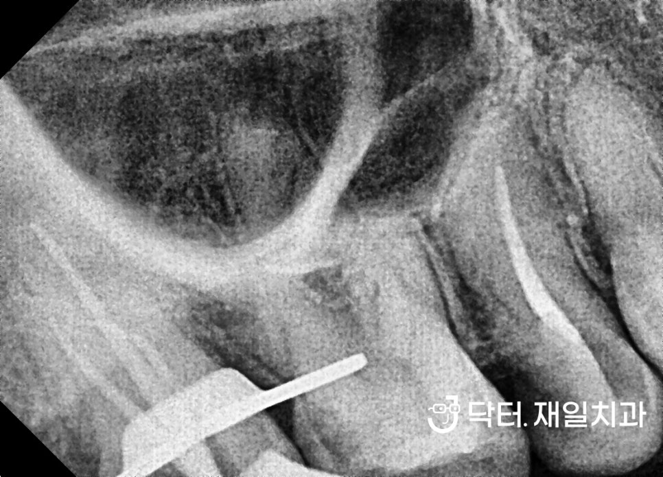 어금니 임플란트 수술이 필요한 치과마취트라우마 30대 환자분 당일 수면마취로 명일동 상일동역임플란트 치과에서 크라운 신경치료까지 한번에