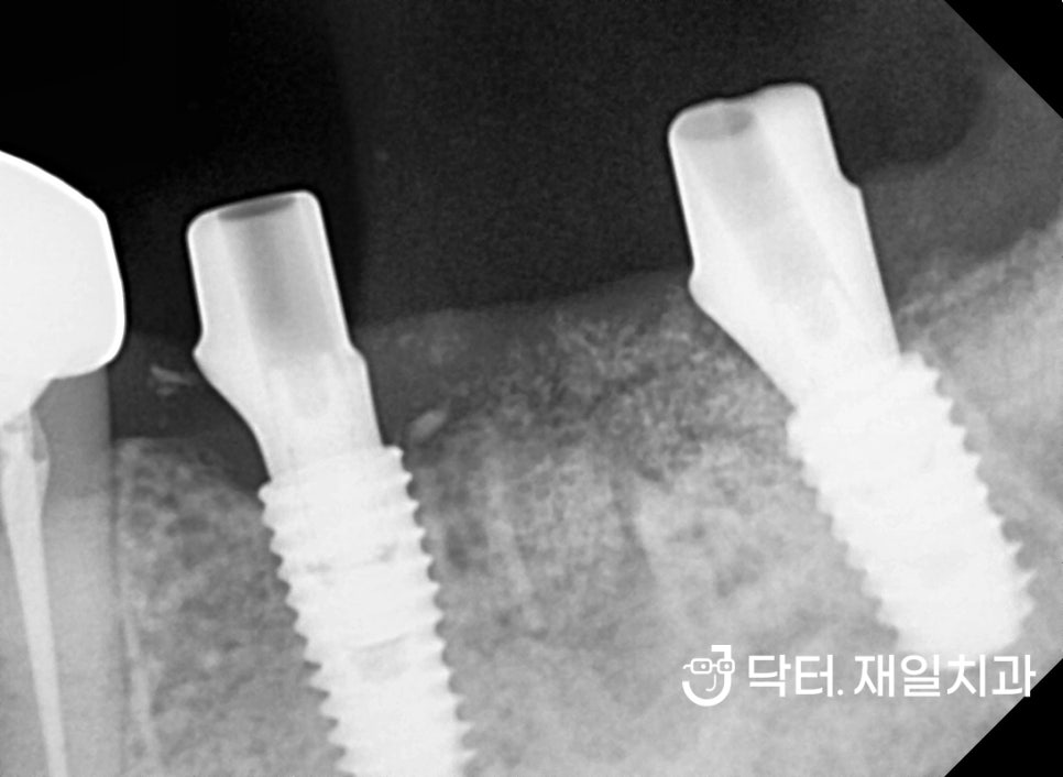 어금니 임플란트 수술이 필요한 치과마취트라우마 30대 환자분 당일 수면마취로 명일동 상일동역임플란트 치과에서 크라운 신경치료까지 한번에