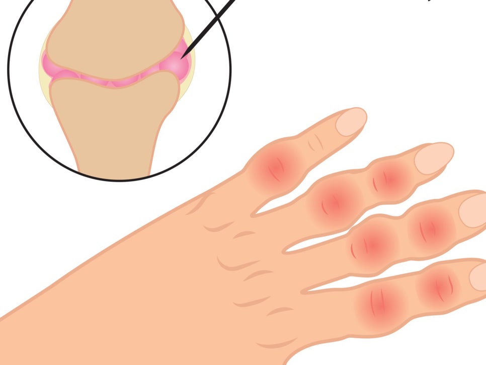 손가락 마디 관절 통증 원인 및 증상(부었을때, 관절염, 가성통풍)