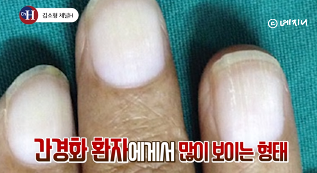 엄지 손톱 검은 세로줄 위험성 정리