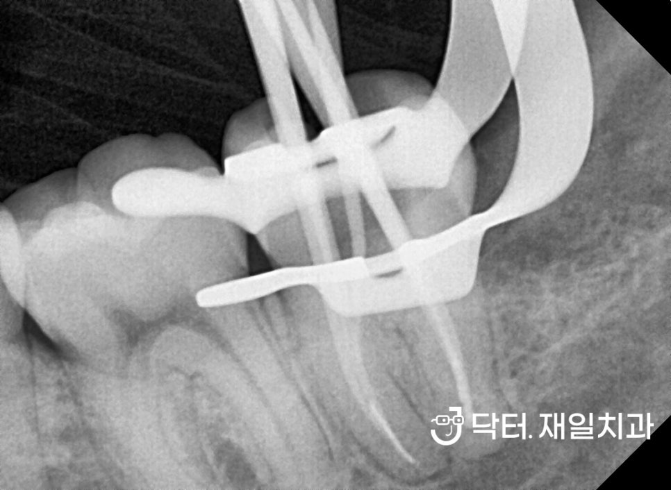 누워서나온 부분매복사랑니발치 꼭 해야하는 이유와 어금니옆면충치 일요일신경치료 치과에서 수면마취로