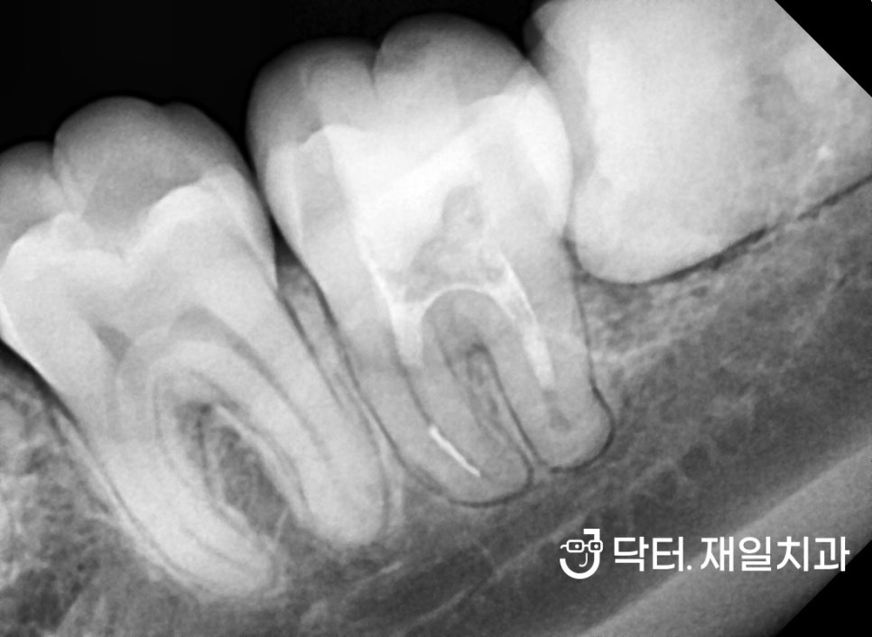 누워서나온 부분매복사랑니발치 꼭 해야하는 이유와 어금니옆면충치 일요일신경치료 치과에서 수면마취로