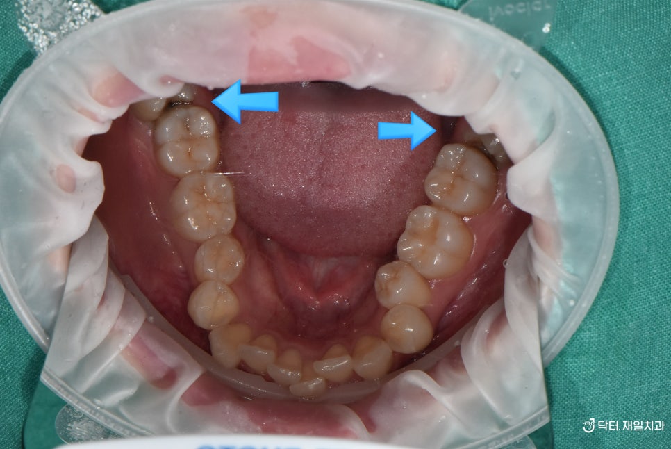 누워서나온 부분매복사랑니발치 꼭 해야하는 이유와 어금니옆면충치 일요일신경치료 치과에서 수면마취로