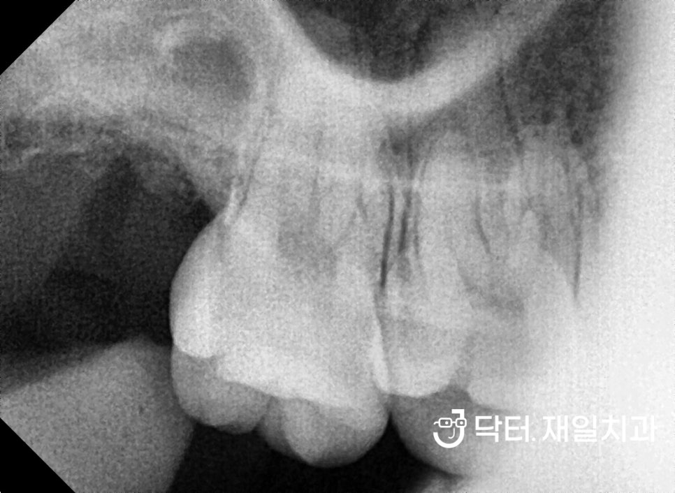 누워서나온 부분매복사랑니발치 꼭 해야하는 이유와 어금니옆면충치 일요일신경치료 치과에서 수면마취로