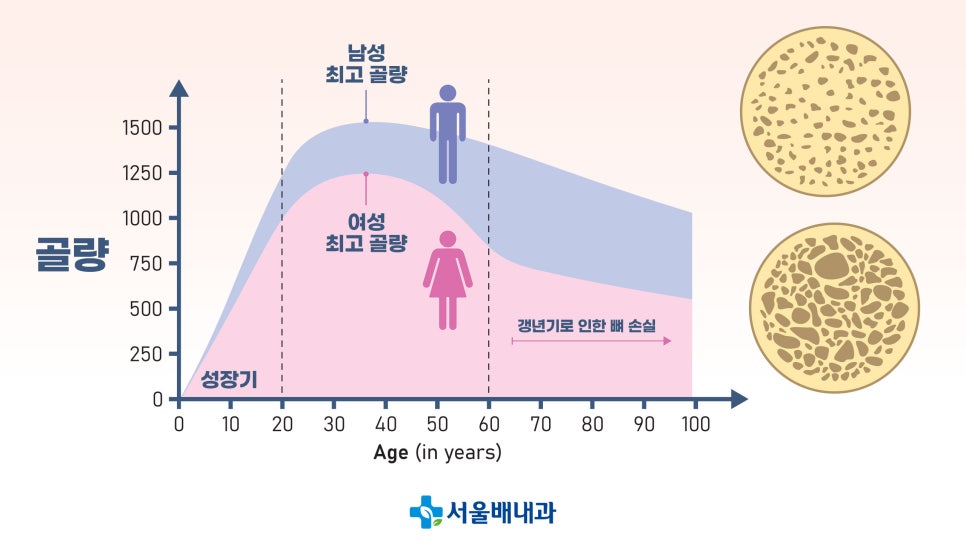 골다공증, 골밀도 결과지 보는 법
