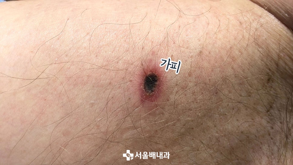 쯔쯔가무시증 증상과 치료는?