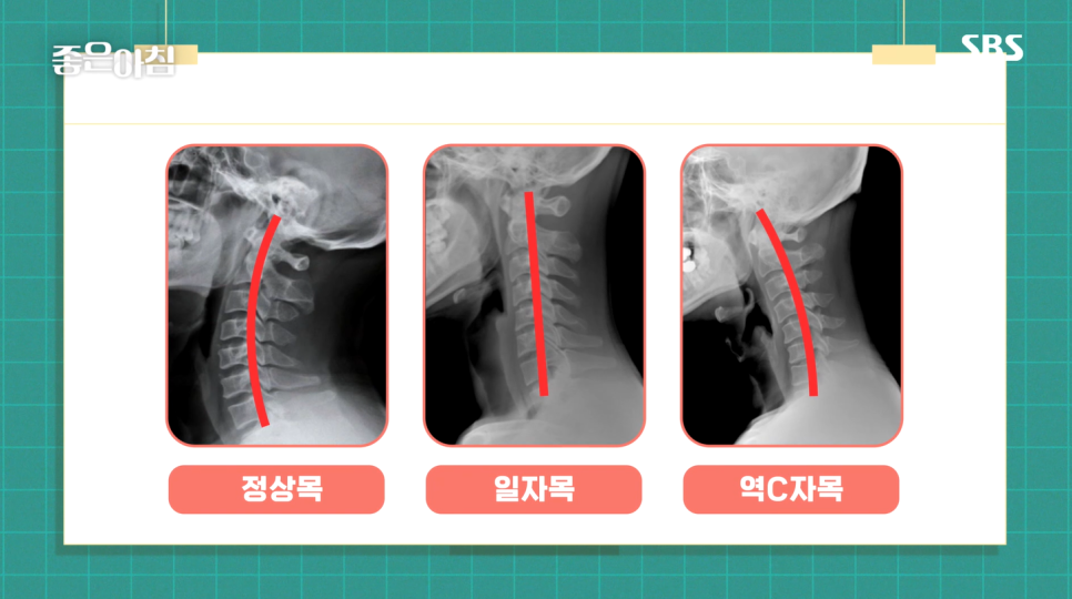 SBS좋은아침 더 건강한 스쿨_인공관절수술 대상자와 목디스크 특강(권유범X김성철 연세사랑병원 의료진)