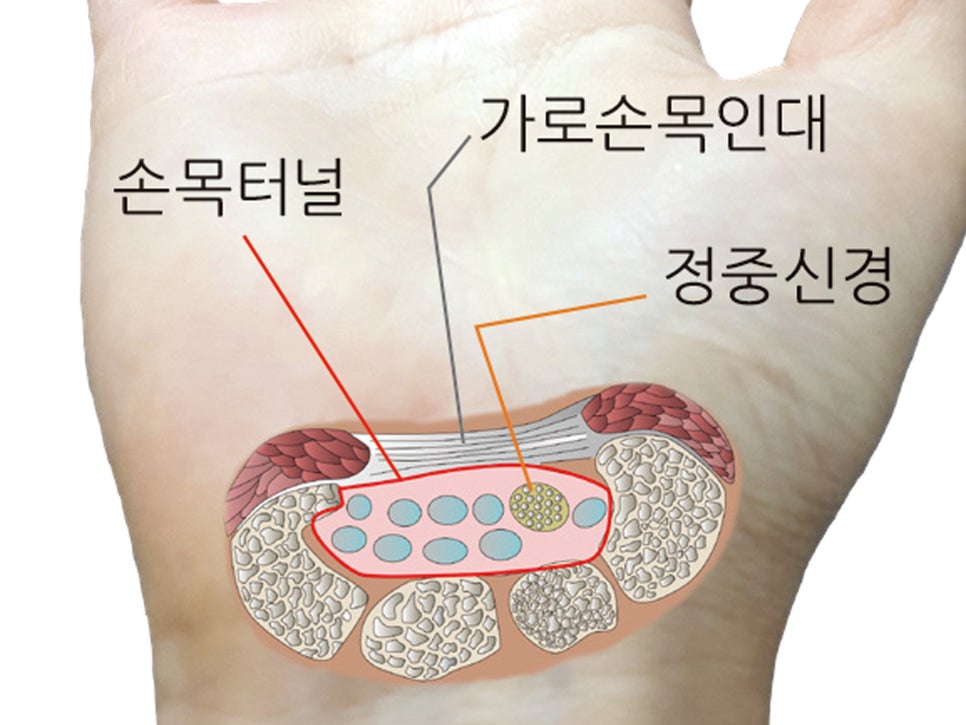 손목터널증후군 증상 및 수술 치료법(손목통증 손저림 손가락저림)