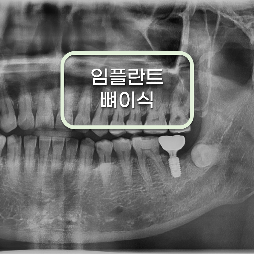 수면마취 치과에서 임플란트 뼈이식 수술 치료 통해 튼튼한 잇몸만들기