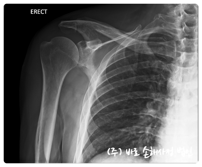 교통사고 쇄골골절 치료방법과 합의금에 대한 안내