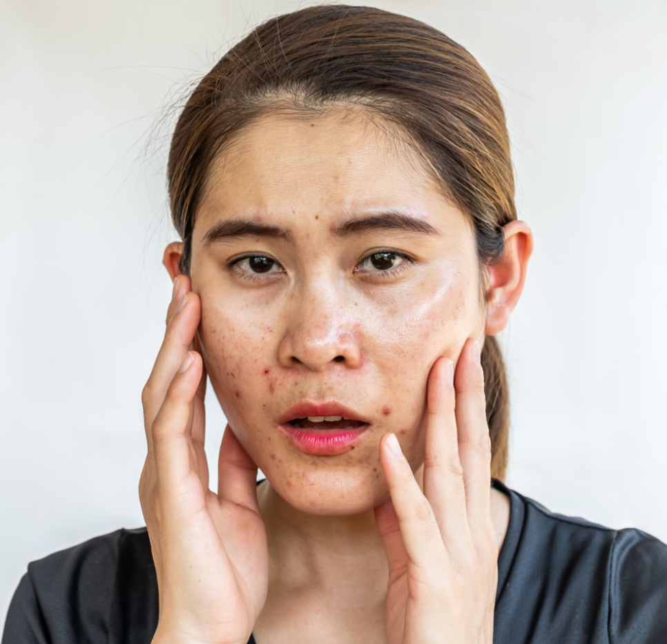 수부지 피부 속건조 특징 뜻 해결하는 수분크림 추천