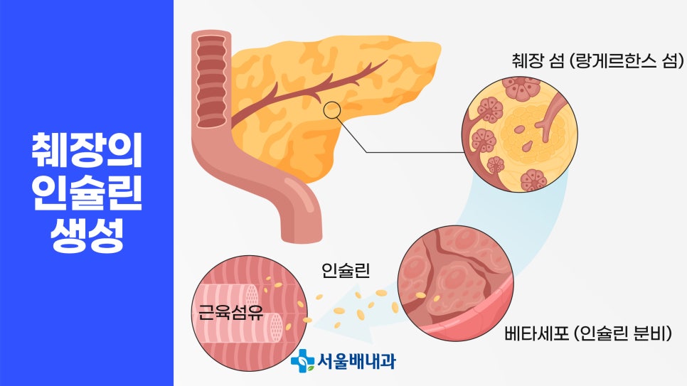 당뇨병성 케톤산증 원인, 증상, 진단과 치료, 인슐린 부족