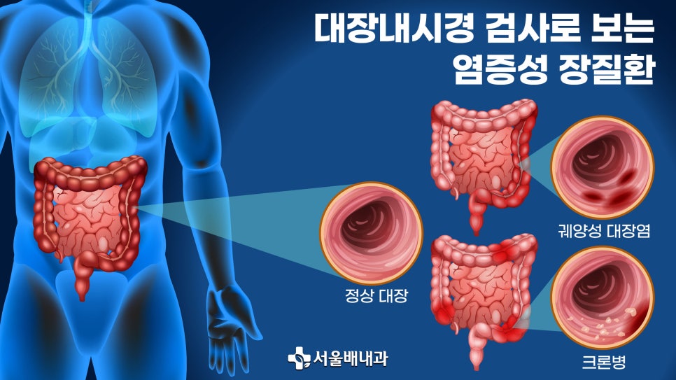 과민성대장증후군, 저포드맵식단이란, 서울배내과