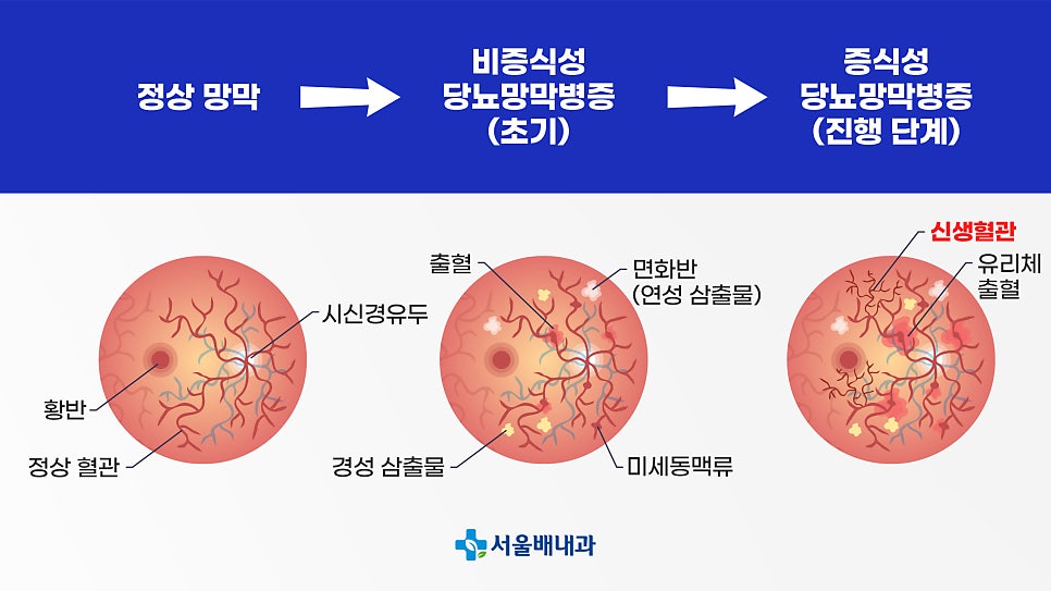 당뇨병과 눈 합병증, 혈당관리, 당뇨 치료