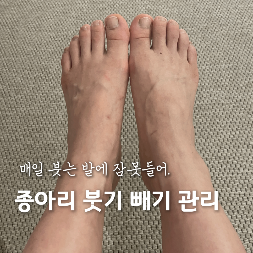 종아리 붓기 빼기 관리 부소환과 발이 붓는 이유
