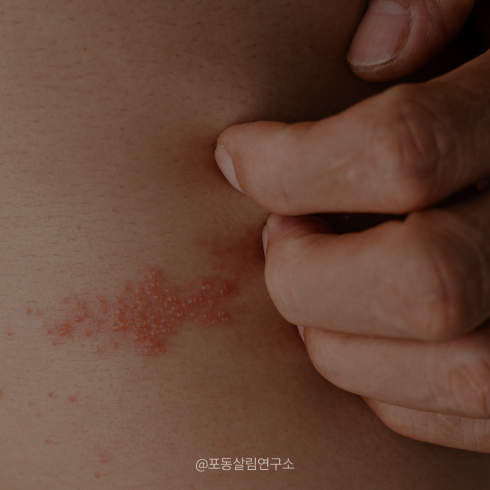 대상포진 초기증상, '이것' 모르면 평생 후회할 수도 있어요
