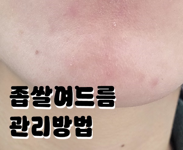 좁쌀여드름 없애기 직장인 꿀루틴 (하루 3분)