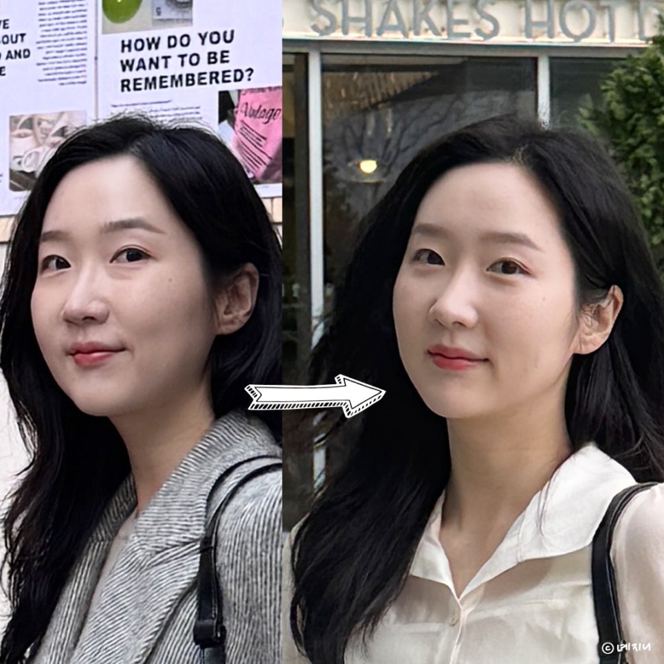 눈밑지방재배치 3개월차 후기! 효과 & 부작용은?