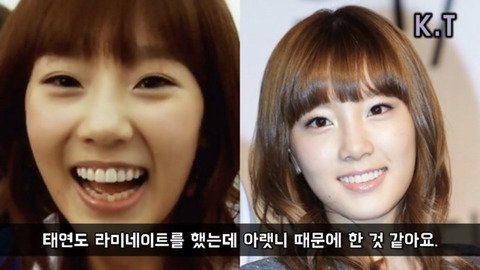 라미네이트 부작용 겪은 연예인 모음.zip (삭제 vs 무삭제 차이?)