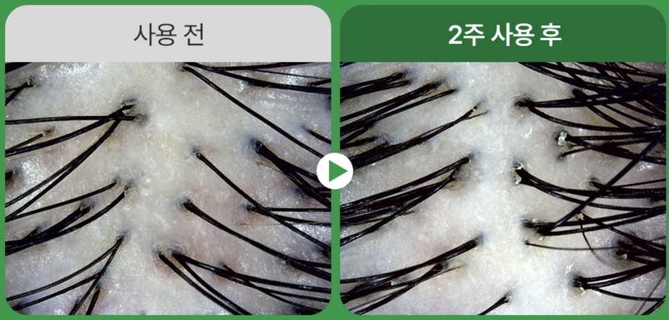 김신영 발땀 발샴푸 두피냄새 두피템 정보 나혼산